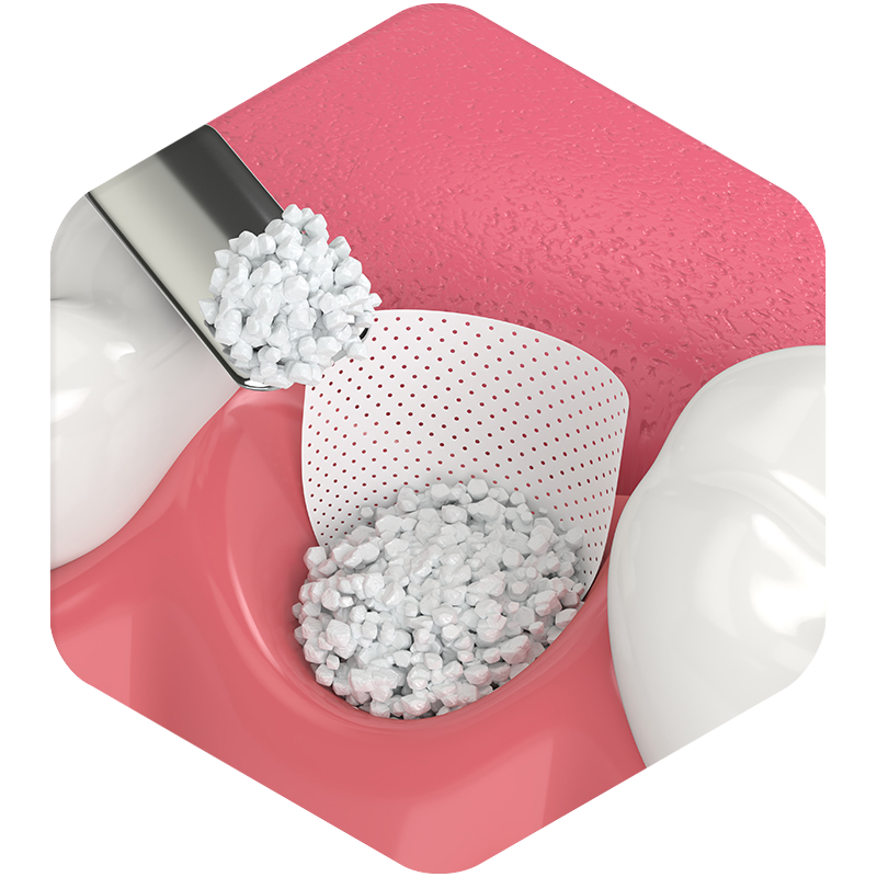 3D illustration of a dental bone graft procedure.